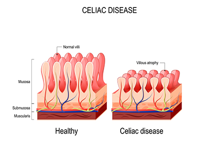 Celiac Disease: Symptoms Diagnosis Diet And Treatment