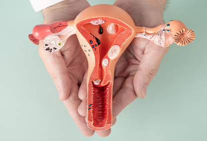 Uterine Fibroids: Exploring Treatment