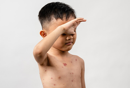 Chicken Pox Symptoms and Treatment: What You Need To Know